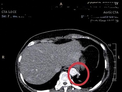 肺结节：一味中药宣肺散结，常泡它，气顺痰消结节安！