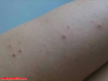 人长红痣不是无缘无故！医生提醒：或是潜藏了这些疾病，别大意了