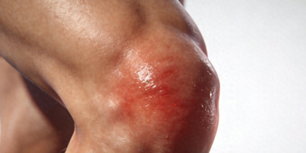 湿痹疼痛克星！喷一下通经络，全身湿气排净，缓解疼痛不适