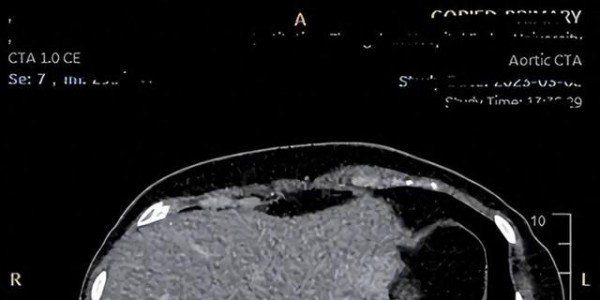 肺结节：一味中药宣肺散结，常泡它，气顺痰消结节安！