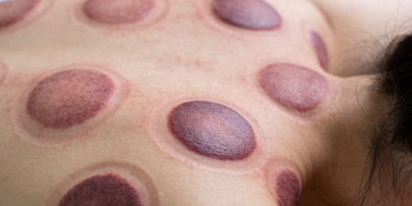 拔罐后总是发紫发疼？中医提醒：不是越紫越好，这3点要弄清楚