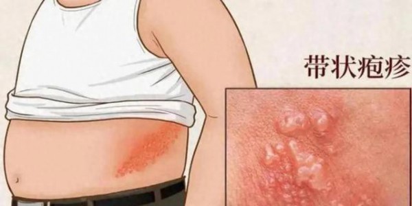 带状疱疹别硬扛！民中医针灸科中西医结合治疗有妙招~