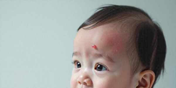 宝宝脸起蚊子红包别慌！正确处理步骤全解析，消包快还不伤皮肤