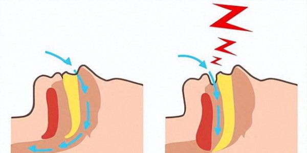 别把打鼾当睡得香！锻炼疏通气道，改善睡眠呼吸暂停