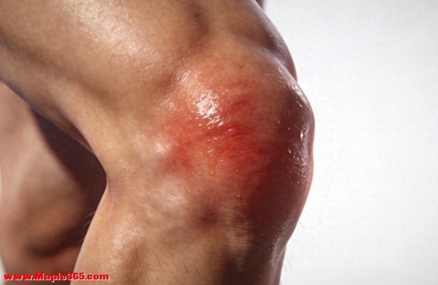 湿痹疼痛克星！喷一下通经络，全身湿气排净，缓解疼痛不适