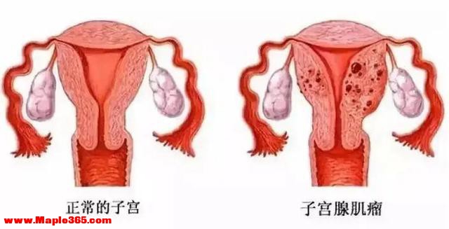38周剖腹产，肌瘤比宝宝还大：医生扒开子宫肌瘤，才找到孩子的头-12.jpg