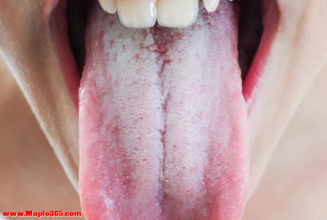 舌边有齿痕，舌中有裂纹？哪里出了问题？中医一次给你讲清楚-2.jpg
