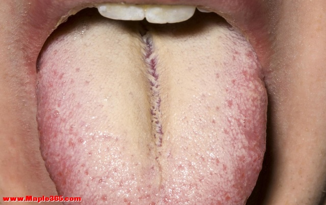 舌边有齿痕，舌中有裂纹？哪里出了问题？中医一次给你讲清楚-3.jpg