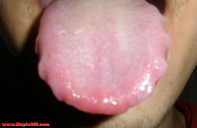 舌边有齿痕，舌中有裂纹？哪里出了问题？中医一次给你讲清楚-6.jpg